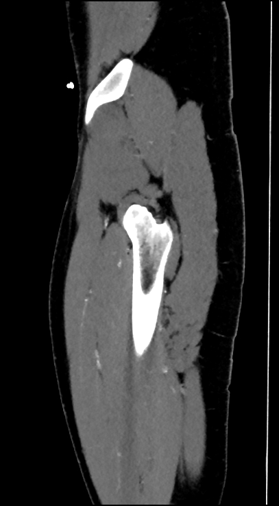 Normal pelvis CT angiogram (Radiopaedia 84966-100481 C 12).jpg
