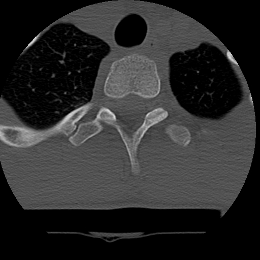 File:Normal trauma spine imaging (age 16) (Radiopaedia 45335-49358 Axial bone window 83).jpg