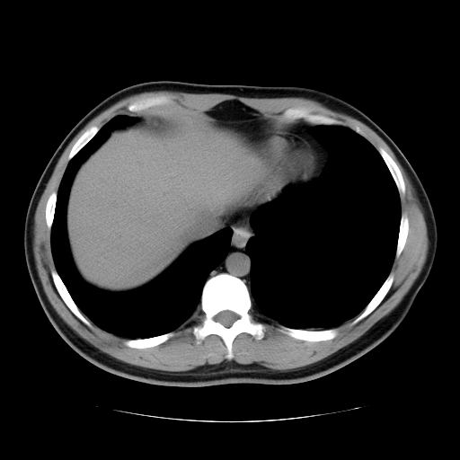 File:Obstructing ureteric calculus (Radiopaedia 18615-18514 Axial non-contrast 8).jpg