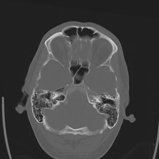 File:Obstructive hydrocephalus (Radiopaedia 30453-31119 Axial bone window 25).jpg
