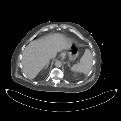 File:Obstructive pyelonephritis (Radiopaedia 46411-50844 Axial non-contrast 17).png
