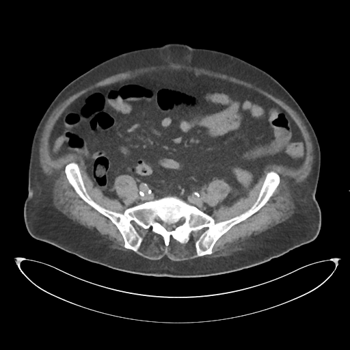 File:Obstructive pyelonephritis (Radiopaedia 46411-50844 Axial non-contrast 56).png