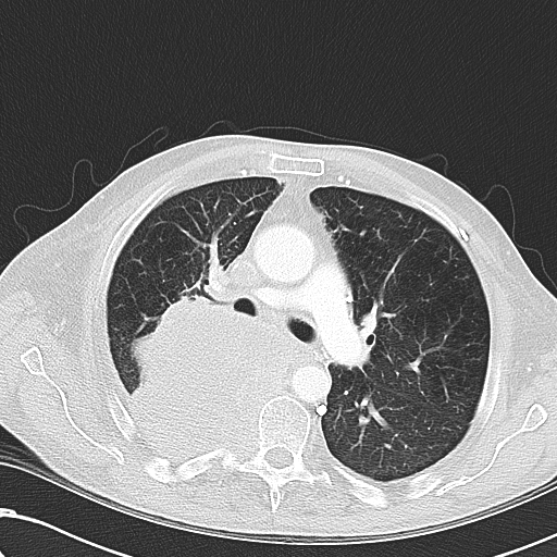 File:Obstructive superior vena cava tumor thrombus (Radiopaedia 28046-28306 Axial lung window 22).jpg