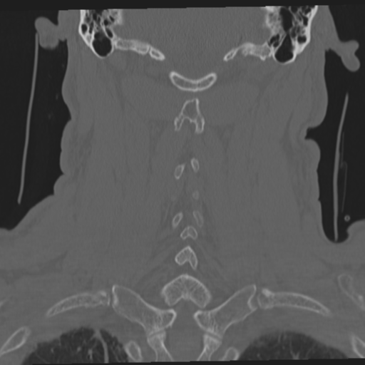 File:Occipital condyle fracture (Radiopaedia 33467-34517 Coronal bone window 48).png