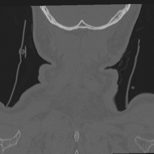 File:Occipital condyle fracture (Radiopaedia 33467-34517 Coronal bone window 71).png