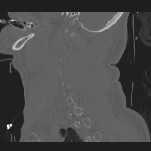 File:Occipital condyle fracture (Radiopaedia 33467-34517 Sagittal bone window 56).png