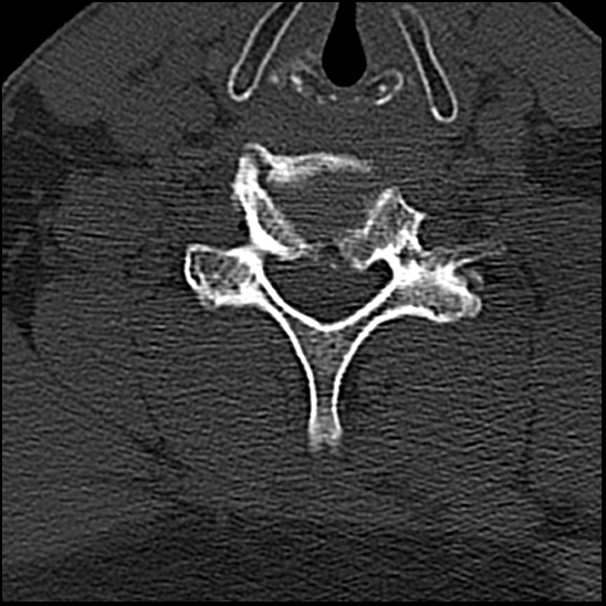 Occipital condyle fracture (type 1) (Radiopaedia 87670-104084 Axial bone window 64).jpg