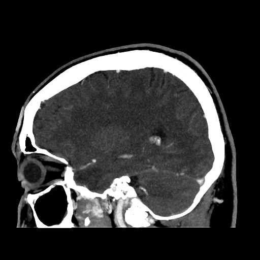 Occipital extradural hematoma simulating venous sinus thrombosis (Radiopaedia 46514-50964 D 26).jpg