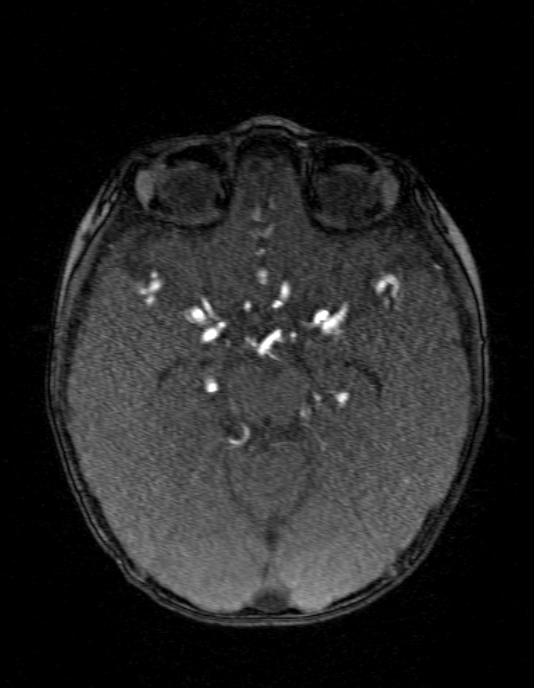 Occipital horn syndrome (Radiopaedia 14255-14129 MRA 65).jpg