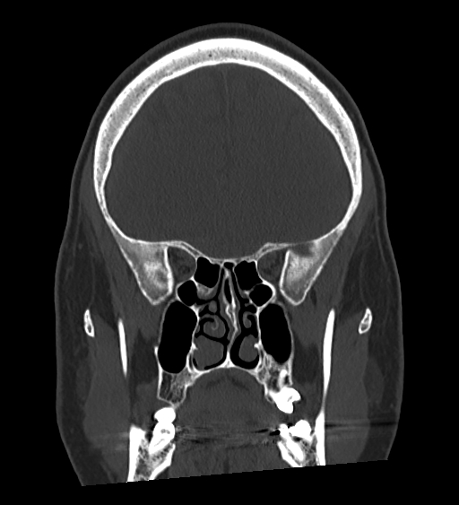 Occipital spur and Currarino type A atlas anomaly (Radiopaedia 87027-103285 Coronal bone window 57).jpg