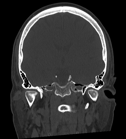 Occipital spur and Currarino type A atlas anomaly (Radiopaedia 87027-103285 Coronal bone window 81).jpg