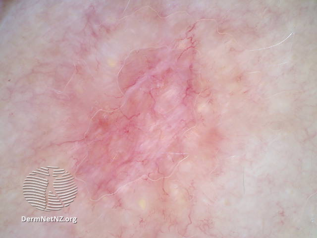 File:Prominent blood vessels, polarised white lines, and yellowish clods (DermNet NZ doctors-dermoscopy-course-images-crystalline2).jpg