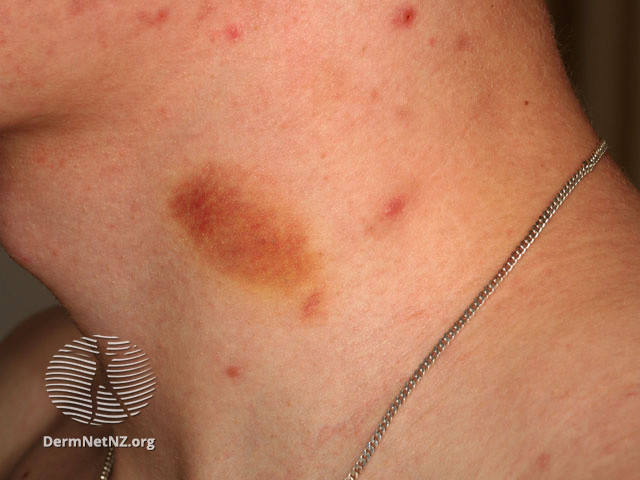 File:Suction bruise (DermNet NZ vascular-s-purpura1).jpg