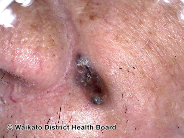 File:Ulcerated basal cell carcinoma (DermNet NZ basal-skin-of-colour-03).jpg