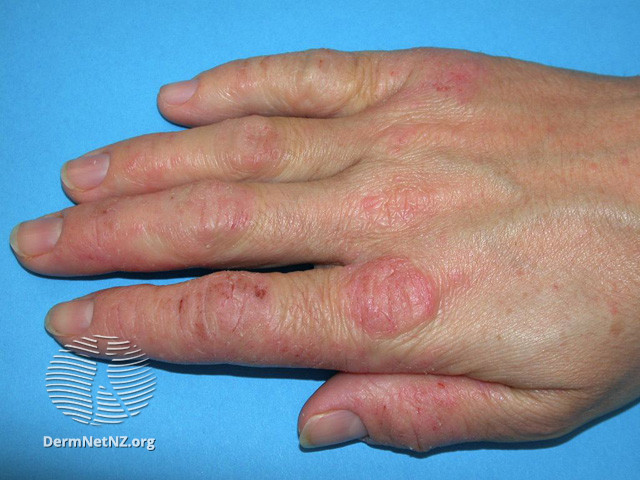 File:(DermNet NZ dermatitis-hand-dermatitis-2845).jpg