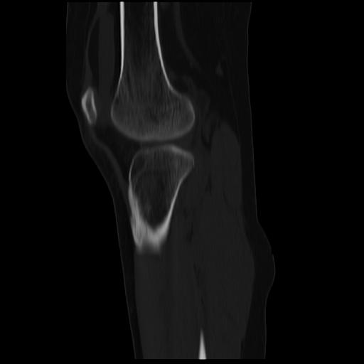 File:ACL avulsion fracture (Radiopaedia 33833-34994 Sagittal bone window 16).jpg