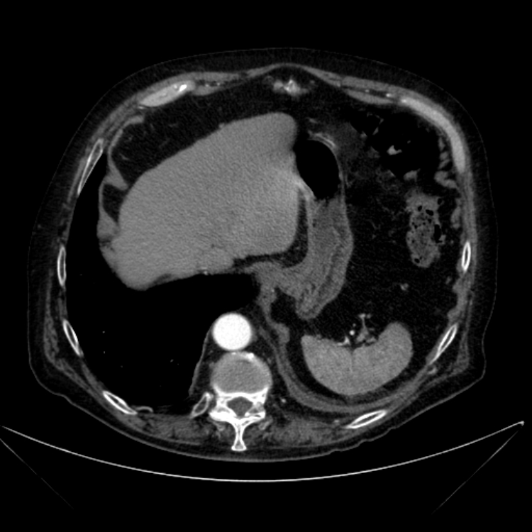 Abdominal aortic aneurysm (Radiopaedia 25855-26001 Axial C+ arterial phase 26).jpg