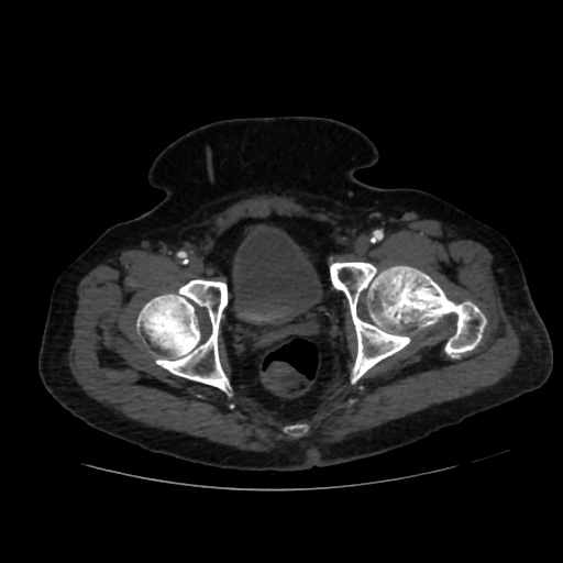 File:Abdominal aortic aneurysm (Radiopaedia 57318-64259 Axial C+ arterial phase 72).jpg
