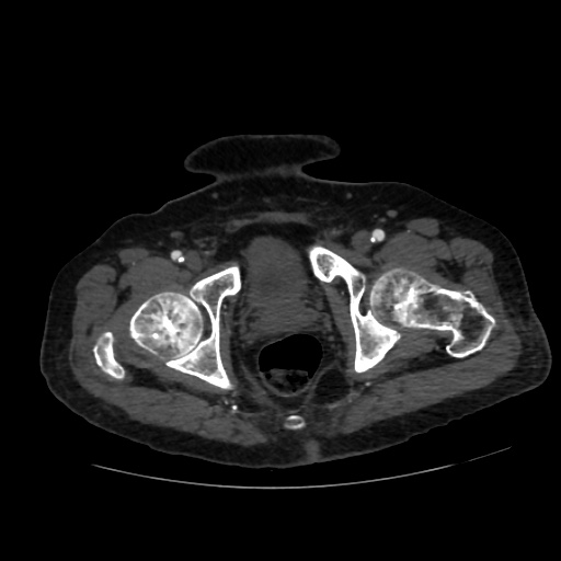 File:Abdominal aortic aneurysm (Radiopaedia 57318-64259 Axial C+ arterial phase 74).jpg