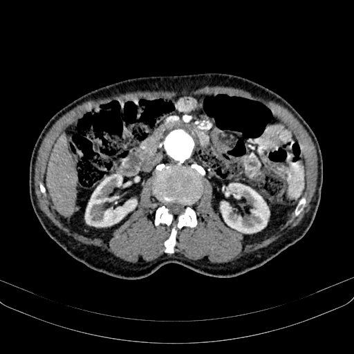 Abdominal aortic aneurysm (Radiopaedia 83581-98689 Axial C+ arterial phase 54).jpg