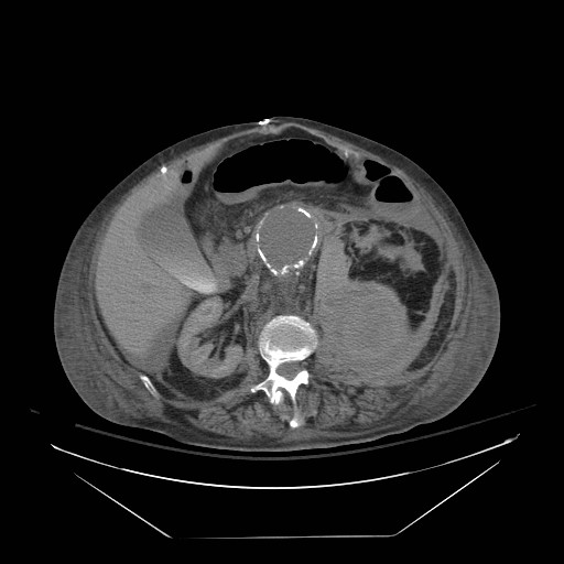 Abdominal aortic aneurysm - impending rupture (Radiopaedia 19233-19247 Axial non-contrast 77).jpg