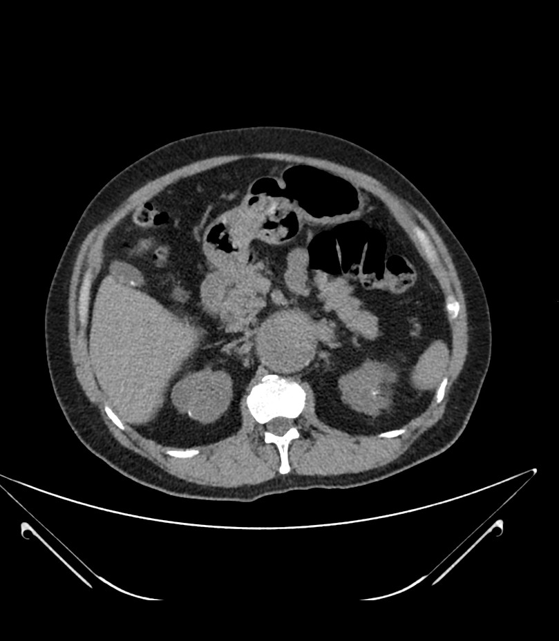 Abdominal aortic aneurysm with thrombus fissuration (Radiopaedia 46218-50618 Axial non-contrast 17).jpg