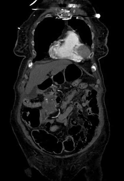 Abdominal aortic aneurysm with thrombus fissuration (Radiopaedia 73192-83919 Coronal C+ arterial phase 10).jpg