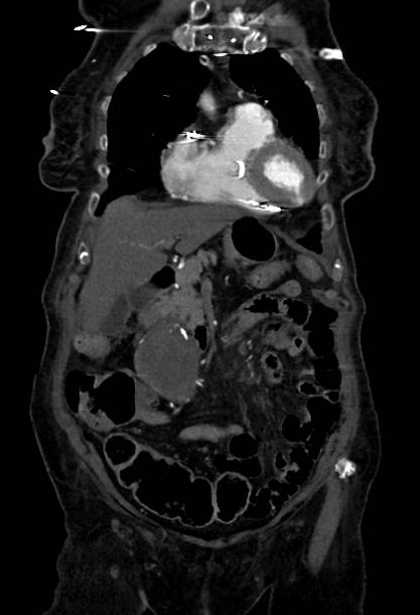 Abdominal aortic aneurysm with thrombus fissuration (Radiopaedia 73192-83919 Coronal C+ arterial phase 14).jpg