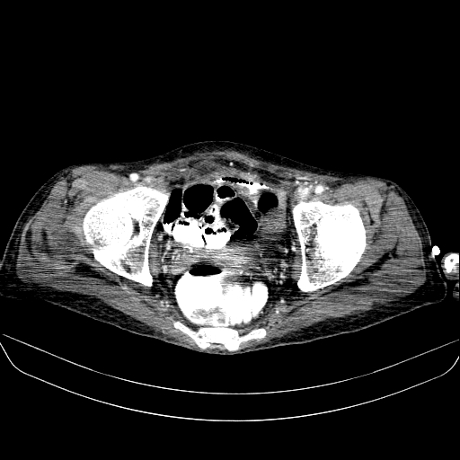 File:Abdominal collection due to previous cecal perforation (Radiopaedia 80831-94320 Axial C+ portal venous phase 188).jpg
