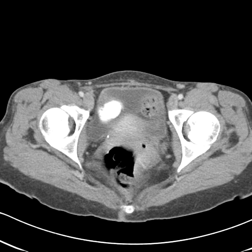 Abdominal desmoid tumor (Radiopaedia 41007-43740 Axial C+ portal venous phase 68).png
