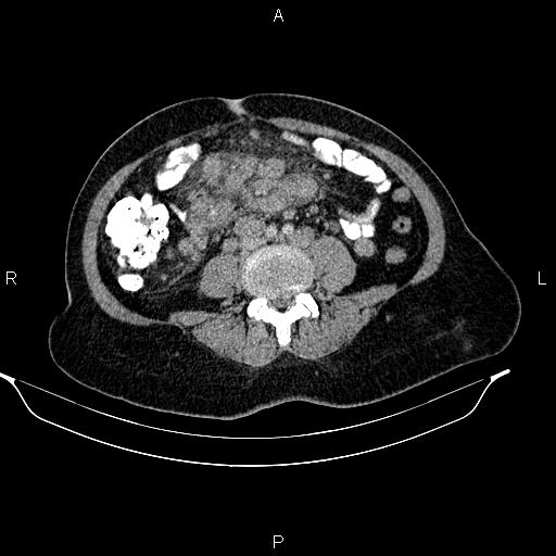 Abdominal lymphoma with sandwich sign (Radiopaedia 84378-99704 Axial C+ portal venous phase 36).jpg