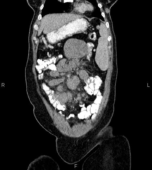 Abdominal lymphoma with sandwich sign (Radiopaedia 84378-99704 Coronal C+ portal venous phase 7).jpg