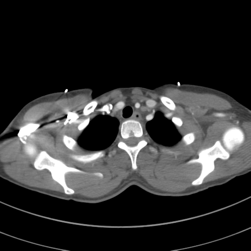 File:Abdominal multi-trauma - devascularised kidney and liver, spleen and pancreatic lacerations (Radiopaedia 34984-36486 Axial C+ arterial phase 14).png
