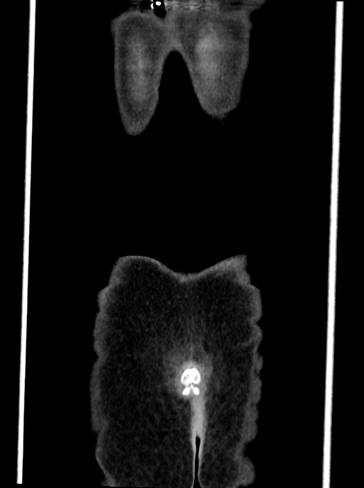 Abdominal wall and retroperitoneal tuberculosis (Radiopaedia 88137-104729 Coronal C+ portal venous phase 104).jpg
