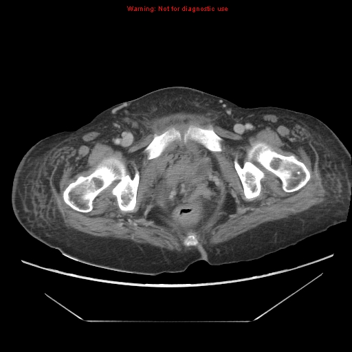 File:Abdominal wall hematoma (Radiopaedia 9427-10112 Axial C+ portal venous phase 106).jpg