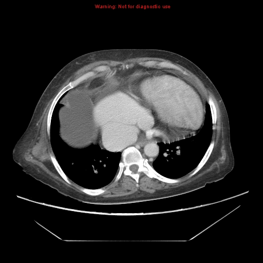 File:Abdominal wall hematoma (Radiopaedia 9427-10112 Axial C+ portal venous phase 11).jpg