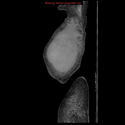Abdominal wall hematoma (Radiopaedia 9427-10112 Sagittal C+ portal venous phase 108).jpg