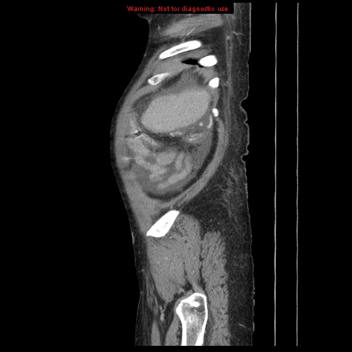 Abdominal wall hematoma (Radiopaedia 9427-10112 Sagittal C+ portal venous phase 14).jpg
