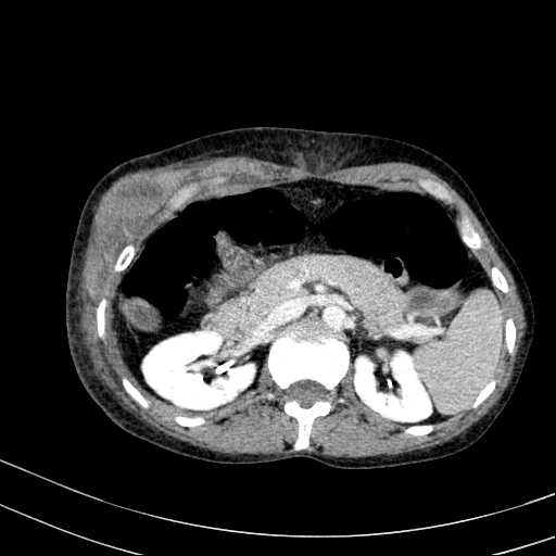 Abdominal wall hematoma with active bleeding (Radiopaedia 83915-99117 Axial C+ portal venous phase 15).jpg