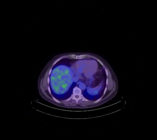 Abdominal wall metastasis from colorectal carcinoma (Radiopaedia 31016-31719 Axial 95).jpg