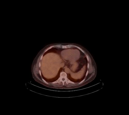 Abdominal wall metastasis from colorectal carcinoma (Radiopaedia 31016-31719 C 94).jpg