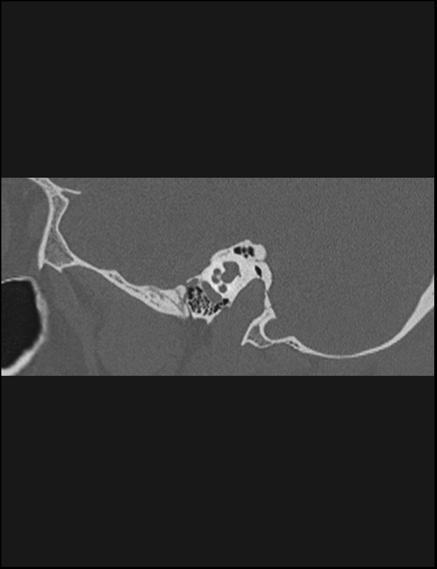 Aberrant right internal carotid artery (Radiopaedia 65191-74198 Sagittal non-contrast 57).jpg