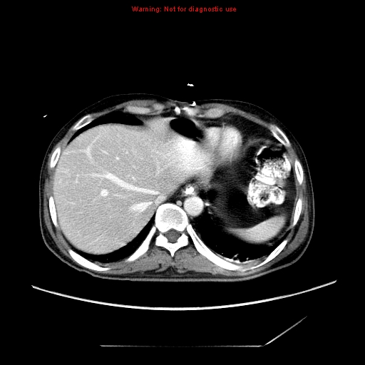 File:Aberrant right subclavian artery (Radiopaedia 9379-10071 Axial C+ arterial phase 56).jpg