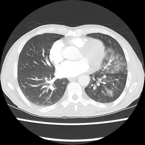 Accessory left horizontal fissure with lingular pneumonia (Radiopaedia 53763-59843 Axial lung window 35).jpg