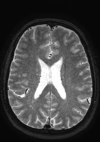 Accessory middle cerebral artery (Radiopaedia 73114-83828 Axial T2 28).jpg