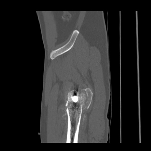 File:Acetabular and ilial fractures (Radiopaedia 59084-66378 Sagittal bone window 89).jpg