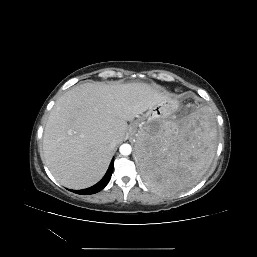 Acinar cell carcinoma of the pancreas (Radiopaedia 75442-86669 Axial C+ portal venous phase 22).jpg