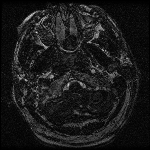 File:Acoustic schwannoma (Radiopaedia 39170-41387 Axial FIESTA 8).png