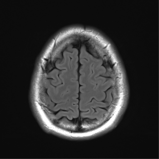 File:Acoustic schwannoma (Radiopaedia 50846-56358 Axial FLAIR 27).png