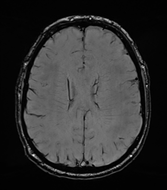 Acoustic schwannoma (Radiopaedia 50846-56358 Axial SWI 61).png